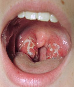 An ulcerated throat associated with scarlet fever (Wikimedia Commons)